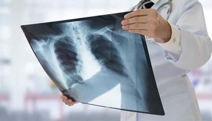 আপনি কোভিড আক্রান্ত কি না ধরা পড়বে X-Ray-তেও দাবি বিজ্ঞানীদের