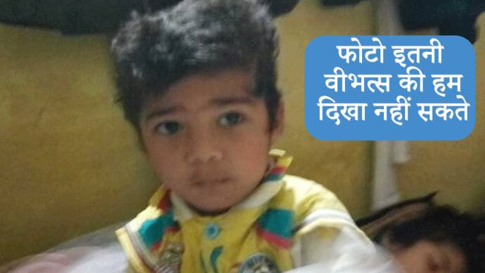 5 साल के बच्चे की दोनों आंखें निकल आईं बाहर, पिता कमाता है 6 हजार और इलाज का खर्च 25 लाख रुपए