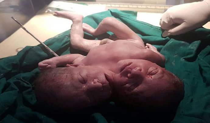 कोरोना की त्रासदी में कोख में ही थम गई धड़कन, पैदा हुआ 2 सिर और एक धड़ वाला बच्चा
