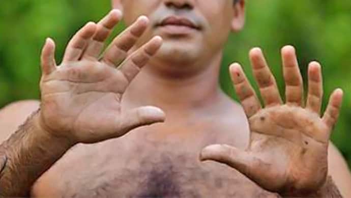 जिन लोगों के हाथों में होती हैं 10 से ज्यादा उंगलियां, वो होते हैं किस्मत वाले