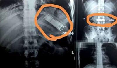 7 महीने तक शख्स के पेट के अंदर ही बजती रही 'घंटियां', डॉक्टर्स ने सर्जरी कर इस हाल में बाहर निकला मोबाइल फोन