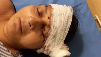 भगवान बने डॉक्टर: महिला के सिर में 8 इंच धंसी कुल्हाड़ी, 4 घंटे में यूं कमाल कर उसे मौत के मुंह से निकाला