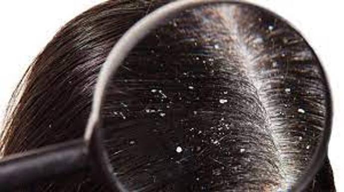 Hair Care: শীতকালে খুশকি নিরাময়ের অব্যর্থ টোটকা, এই সাধারন উপাদান করবে ম্যাজিকের মত কাজ
