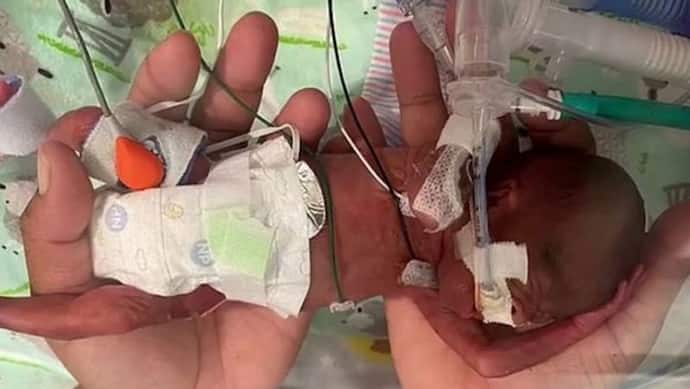 Shocking: दुनिया के उस बच्चे के जिंदा बचने की कहानी, जो सिर्फ 20 हफ्ते में मां की गर्भ से निकला बाहर