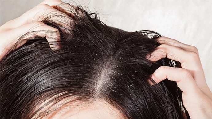 winter care: सर्दी में गर्म पानी से बाल की निकल गई खाल! इन नुस्खों से दूर करें डैंड्रफ समेत कई  Hair Problems