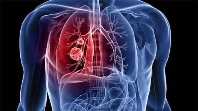 World Lung Cancer Day 2022: इस देश के युवा स्मोकिंग से जीवन भर रहेंगे दूर, जानें फेफड़े के कैंसर में स्मोकिंग 