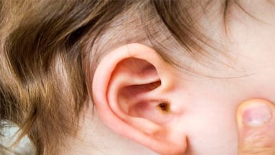 World Hearing Day: आप भी ईयरबर्ड से कान को करते है साफ? हो जाए सावधान! ये है कान साफ करने का बेस्ट तरीका