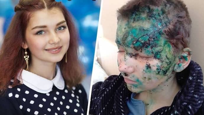 Shocking Picture: 15 साल की लड़की के घर पर गिरा था बम,  नीला-हरा पड़ गया चेहरा, क्या हो सकती है इसकी वजह?