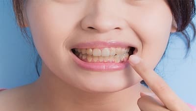 Oral Health: आपके सफेद दांतों को पीला बना सकती है ये 7 चीजें, आज ही बना लें इनसे दूरी