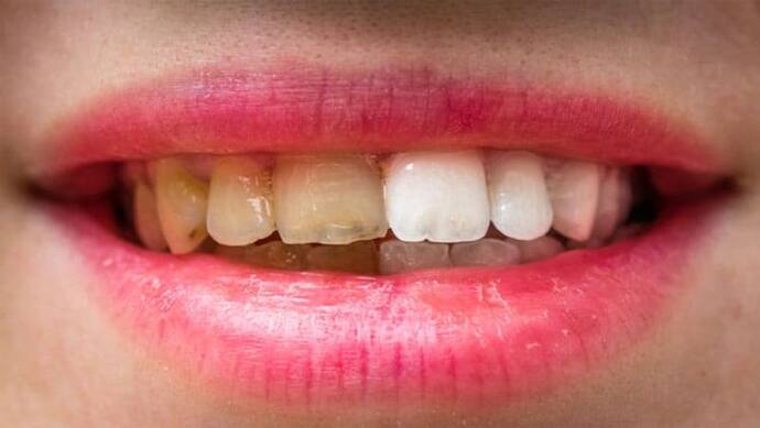 टूथपेस्ट करने से पहले जान लें ये जरूरी बात, कहीं ये दांतों की चमक तो नहीं छीन रहा!