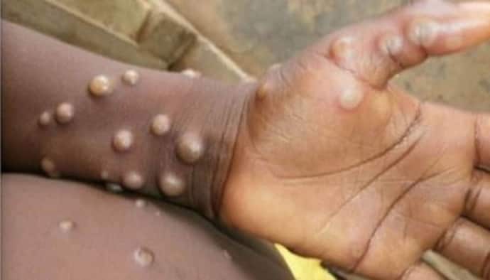 Monkeypox Outbreak: इंसानों में फैलने से रोकने के लिए अपनाने होंगे ये उपाये, WHO ने दी जानकारी