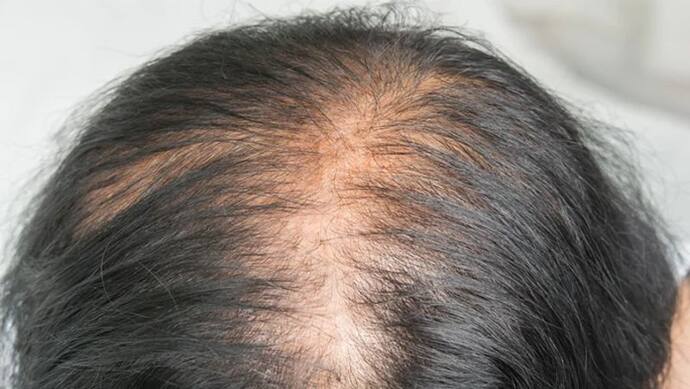गंजेपन से जल्द मिलेगा छुटाकारा,  वैज्ञानिकों ने खोज निकाला बाल उगाने का तरीका