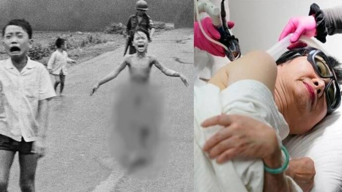 जान बचाने के लिए बिना कपड़ों के भागी इस लड़की ने बताई थी वियतनाम जंग की पीड़ा, 50 साल बाद हुआ अंतिम ऑपरेशन