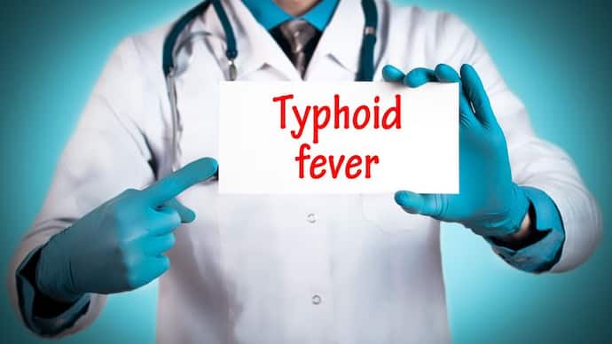 typhoid fever