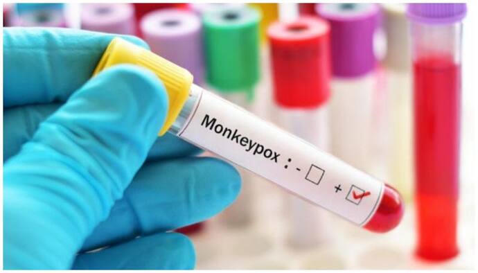 मंकीपॉक्स को WHO ने घोषित किया ग्लोबल पब्लिक हेल्थ इमरजेंसी, 75 देशों के 16 हजार लोगों में फैला यह रोग