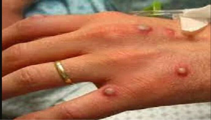 औरैया: महिला में दिखे Monkeypox के लक्षण, जांच के लिए लखनऊ केजीएमयू भेजा गया सैंपल