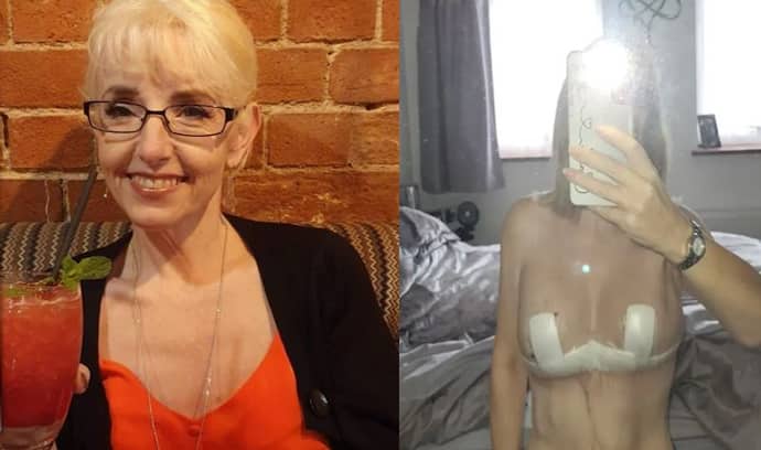 ब्रेस्ट लिफ्ट सर्जरी कराना 53 साल की महिला पर पड़ गया भारी, पैसे भी गंवाई और खूबसूरती भी