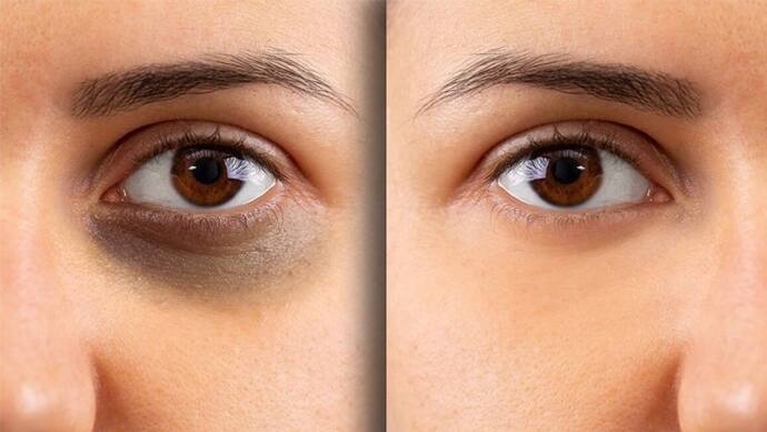 Dark Circles Treatment: इन 5 चीजों के इस्तेमाल से तेजी से कम होने लगेंगे आंखों के नीचे के काले घेरे