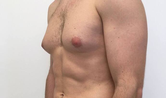  पुरुषों में स्तन क्यों निकल आते हैं? जानें इस समस्या से कैसे पाएं छुटकारा