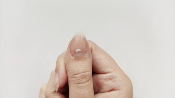 White marks on Nails