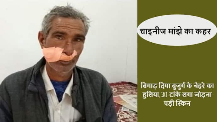 राजस्थान में मौत की डोर का कहरः बुजुर्ग के चेहरे का हुलिया ही बिगाड़ दिया इस मांझे ने, 30 टांके आए फेस पर