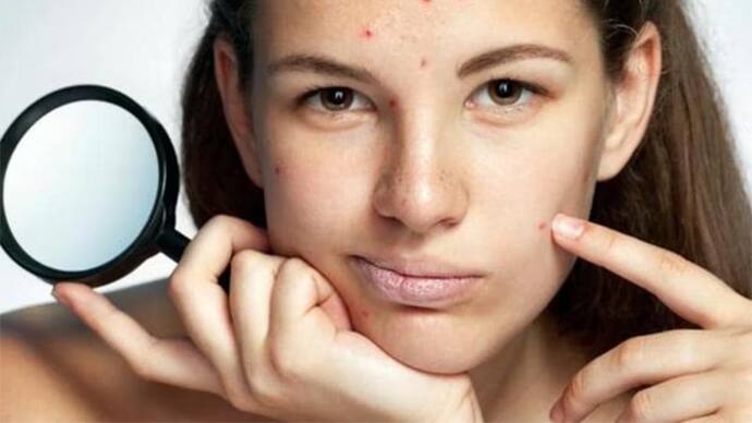 how to prevent acne breakouts before period