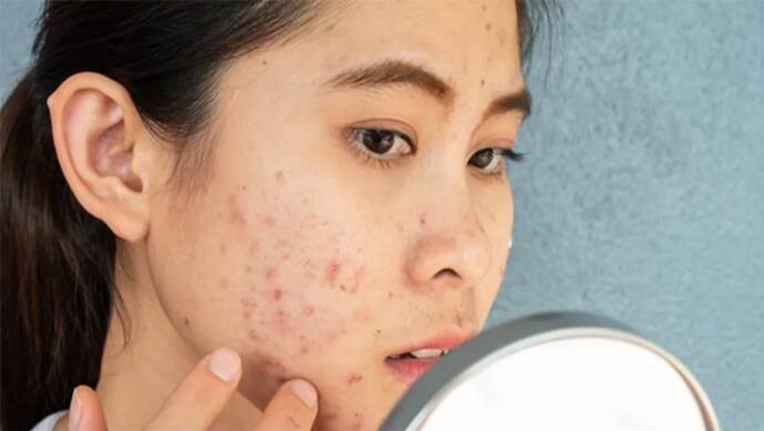 how to avoid pimples problems due to makeup