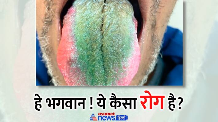 Green Hairy Tongue Syndrome