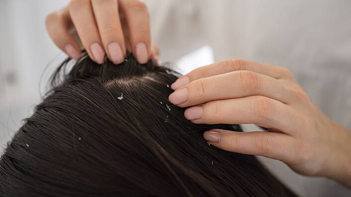 how-to-get-rid-of-thick-dandruff