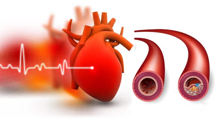 Heart Blockage Ayurvedic Therapy