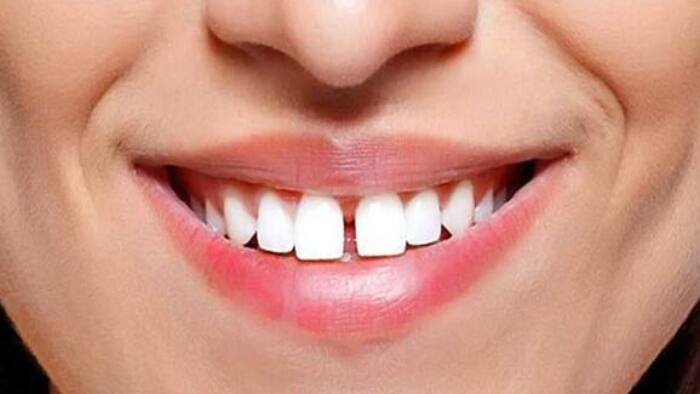 Meaning of gap teeth