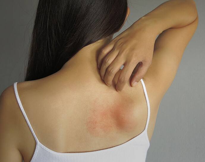 Allergy rash